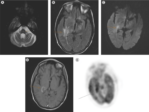 Figure 1. Images of case 1. T2 MRI image showing hyperintensity representing degeneration in the transverse pontocerebellar tracts and median pontine raphe nuclei (“hot cross bun sign”) (A). FLAIR image showing edema in the medial right temporal lobe (B). Diffusion-weighted MRI image (B = 1000) demonstrating restricted diffusion in the area of FLAIR abnormality (C). Post-gadolinium image demonstrating peripheral enhancement corresponding to the areas of restricted diffusion (D). PET image with right temporal hypermetabolism corresponding to areas of restricted diffusion and enhancement (E).