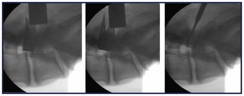 Figure 4 Preoperative and postoperative assessment of decompression using fluoroscopy and a Woodson probe (lateral images [left to right]: pretreatment with MicroBlade Shaver® instrument, post-treatment with MicroBlade Shaver instrument, and post-treatment assessment with Woodson probe).