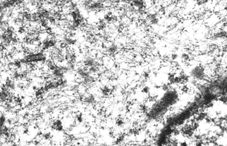 Fig. 5 Protein A immunoelectron microscopic section of a rhabdoid cell from the tumor. The dark spheres over the filaments represents colloidal gold attached to vimentin antibody, × 47,500.