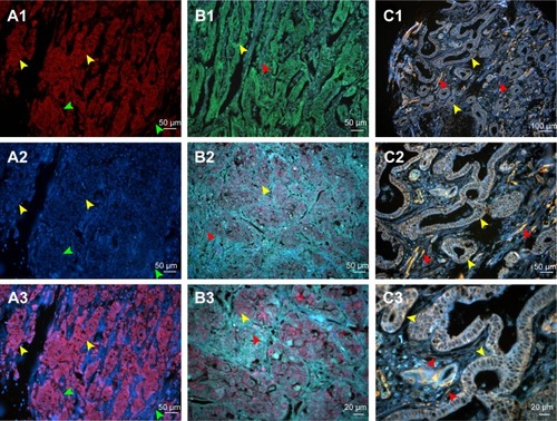 Figure 2 Comparison of conventional fluorescent dyes and QD-based molecular probe.Notes: (A1) The expression of LOX in GC cells revealed by Cy3 fluorescent imaging (excited by 570 nm emission fluorescence, yellow arrows). Cell nuclei are indicated by green arrows. (A2) Cell nucleus revealed by DAPI (green arrows). Cytoplasms are indicated by yellow arrows. (A3) Merged imaging of A1 and A2; LOX expressed in GC cells (yellow arrows) and stromal cells (green arrows). (B1) The expression of LOX in GC revealed by DyLight 488 in GC cells (yellow arrows) and stromal cells (red arrows) (merged image). (B2 and B3) The LOX was stained red and expressed in GC cells (yellow arrows) and stromal cells (red arrows), which was revealed by QDs-655 imaging probes. (C1–C3) The LOX was stained yellow and expressed in GC cells (yellow arrows) and stromal cells (red arrows), which was revealed by QDs-585 imaging probes. Magnification: 200× (A1–A3, B1, B2 and C2), 400× (B3 and C3) and 100× (C1). Scale bar: 50 μm for (A1–A3, B1, B2 and C2), 20 μm for (B3 and C3) and 100 μm for (C1).Abbreviations: QD, quantum dot; LOX, lysyl oxidase; GC, gastric cancer; DAPI, 4′,6-diamidino-2-phenylindole.