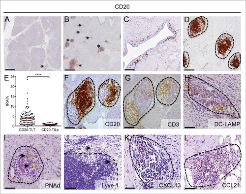Figure 1. B cells strategically localize in tertiary lymphoid tissue in human pancreatic adenocarcinoma. (A–D) Representative images obtained from virtual digital slides of human normal pancreas (A) and pancreatic cancer (B–D), stained for CD20+ B cells. Staining with an anti-CD20 antibody shows few B cells distributed in normal pancreas (arrowhead in A) and at the tumor stroma-interface in PDAC (arrowheads in B and C), while the majority of B cells is located within dense aggregates (asterisks in B and D). (E) Quantitative evaluation of the density of B cells according to their localization within CD20-TLT or as CD20-TILs in tissue specimens from 104 PDAC patients. Density of B cells in TLT (CD20-TLT IRA%) was significantly higher compared to density of scattered CD20-TILs (CD20-TILs IRA%) (****: p < 0.0001 by Student's t test). (F–L) Lymph-node like aggregates (dotted lines) in human PDAC specimens are composed of CD20+ B cells (F), CD3+ T cells (G) and mature dendritic cells expressing DC-LAMP (H). Sections in (F )and (G) panels are consecutive and show the topological compartmentalization of B and T cells. An organized network of specialized PNAd+ high endothelial venules (HEV) (I) and Lyve-1+ lymphatics (J) confirms that the aggregates have features of tertiary lymphoid tissue (TLT). The lymphoid chemokines CXCL13 (K) and CCL21 (L) are present inside lymphoid aggregates. Dotted lines indicate follicle contour. Bars: (A–B) 500 μm, (C–H) 200 μm, (I–L) 100 μm.