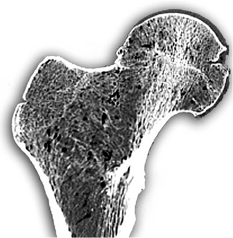 Figure 2. CT image demonstrating the trabeculae in the proximal femur.