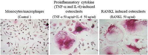 Figure 2. Proinflammatory cytokine (TNF-α and IL-6)-induced osteoclasts differentiated from peripheral blood monocytes (PBMs) in patients with rheumatoid arthritis (RA). Photomicrographs of proinflammatory cytokine (TNF-α and IL-6)-induced osteoclasts and RANKL-induced osteoclasts differentiated from PBMs in patients with RA. Original magnification ×200. Refer Figure 1 for other definitions.