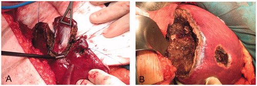 Figure 4. Examples of RF-induced large coagulation zones in the monopolar RF coagulation (MRFC) group. (A) Limited resection in which the monopolar electrode with built-in blade was used as sole sealing and dissecting device. (B) Segmentectomy of segments 5–8, 4a, and two limited resections. Note the thickness of the coagulation zones created on the resection surfaces, which were possibly responsible for the minimal intraoperative bleeding in the MRFC group.