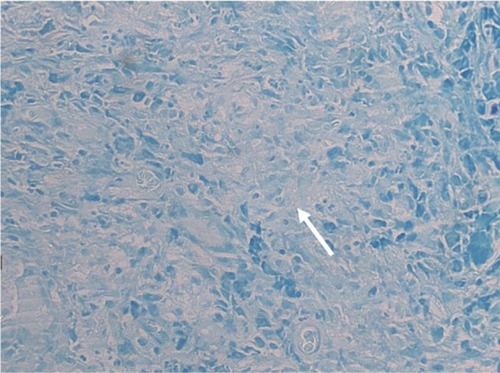 Figure 4 Ziehl–Neelsen histochemical stain prepared on the paraffin block tissue showed positive staining of rare occasional acid-fast bacilli (white arrow) within the epithelioid granulomata and necrotic debris, confirming mycobacterium bacteria.