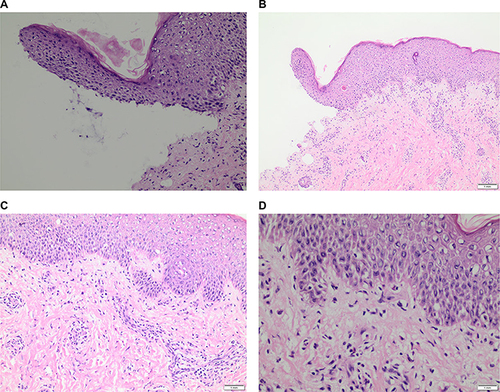 Figure 2 Skin punch biopsy specimen reveals a subepidermal blister (A) with spongiosis (B) and pseudovacuolar changes in the epidermis (C). Superficial perivascular mixed inflammatory infiltrate with eosinophils (D) and mild fibrosis are observed in the dermis.