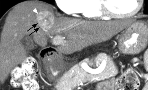 Figure 2 Coronal arterial phase CT image of a 55-year-old man with HBV cirrhosis. Note artery (black arrows) abutting the inferolateral margin of a heterogeneously enhancing HCC (white arrowhead). Patients’ modified heat capacity was 1128 J/°C.