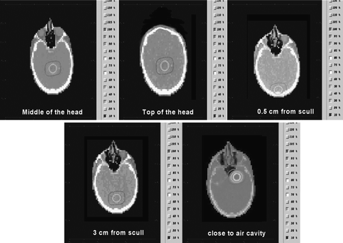 Figure 4.  Isocenter positions for the five cases presented on the CT data set.