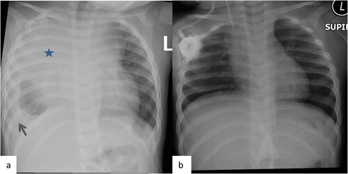 Figure 1. CXR Pre and post Induction. Frontal chest x-ray images (a) at the time of diagnosis and (b) post induction. Large mediastinal opacity (star) is identified in the right Para tracheal of the superior mediastinum. Note also the right side pleural effusion (arrow). Resolution of the mediastinal mass on the chest x-ray post treatment.