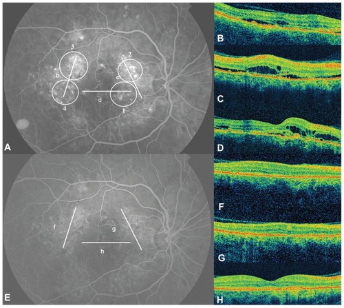 Figure 1 (A) Fluorescein angiography (FA) showing multiple areas of retinal pigment epithelium decompensation. The lines (B–D) correspond to the optical coherence tomography (OCT) scans with the same letter. OCT revealed foveal and perifoveal accumulation of subretinal and intraretinal fluid. The circles represent the area where the photodynamic therapy (PDT) spots where applied. The numbers indicate the order in which the PDT spots were performed. The FA (E) performed 12 months after the PDT session shows retinal pigment epithelium atrophies but not leakage. The OCT scans (F–H) performed on the same areas as the scans before treatment revealed no fluid.