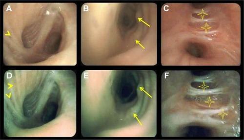 Figure 3 HD WLB (A–C) and i-scan3 (D–F) showing various endobronchial mucosal changes.Notes: A and D show mucosal striations (arrowheads), edema, and stoma; B and E show mucosal nodules (arrows); and C and F show mucosal thinning (stars).