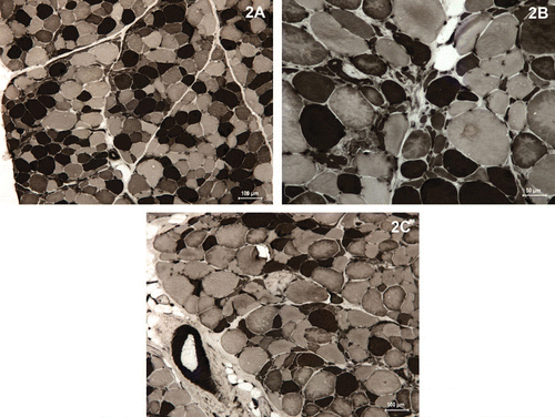 Figure 2.  Transverse sections of triceps (A) and deltoideus (B–C) muscles from a three-year-old dog with a Labrador retriever myopathy. The ATPase reaction at pH 4·6 showing type I (dark), type IIA (pale) and type IIC (intermediate staining) myofibres with several grade of atrophic cells with a high proportion of angulated fibres in both type I and type IIC.