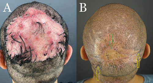 Figure 5 Patient 2: Preoperative FD plaque involving the vertex, mid-scalp extending to the frontal scalp, and acne keloidalis nuchae in the nape area (A) and nineteen months after complete excision of FD lesion and healing by second intention, aided by guarded high-tension sutures and a minor STSG (Green arrow). The tenting skin has flattened out (yellow arrows (B).