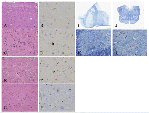 Figure 5. Microscopic findings from the brain and spinal cord. Tissue sections stained with hematoxyline-eosin (A, C, E, G), pTDP-43 (B, D, F, H), and Kluver-Barrera’s stains (I, J, K, L). Frontal lobe (A, B); precentral gyrus (C, D); amygdala (E, F); thalamus (G, H); coronal section of the thalamus (I); axial section of the medulla (J); C7 anterior horn (K); L4 anterior horn (L). Microscopic analysis showed cerebral spongiform degeneration and gliosis in cortical surface layers of the frontotemporal lobes (A, B). The precentral gyrus exhibited reduced numbers of Betz giant cells, atrophying surviving cells, and the presence of macrophages (C, D). The amygdala showed only mild neuronal loss and gliosis (E, F) and the neurons in the thalamus, brainstem, and anterior horn of the spinal cord were well preserved (G-L). pTDP-43 positive structures characterized by short dystrophic neurites and crescentic or oval neuronal cytoplasmic inclusions were found in the frontotemporal cortices, amygdala, and the dentate gyrus of the hippocampus (B, D, F, H).