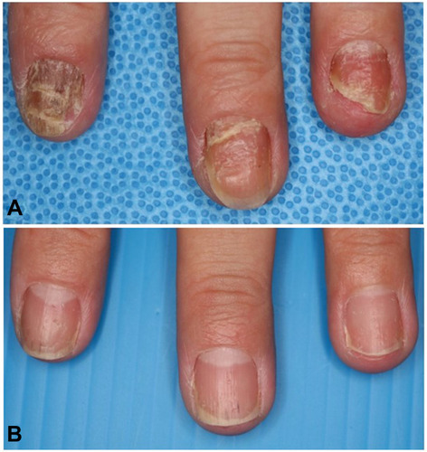 Figure 2 Improvement of PPP nail after tonsillectomy. Before (A) and 1 year after tonsillectomy (B).