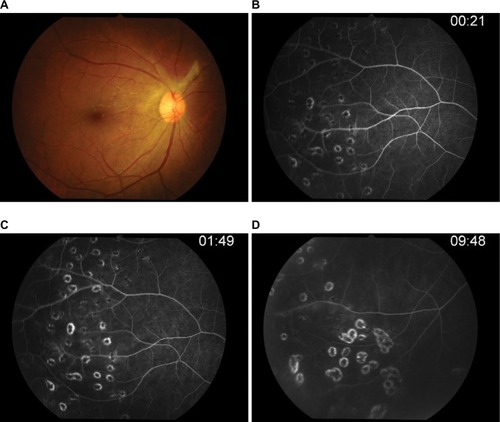 Figure 7 Post-acyclovir after 3 months of therapy.