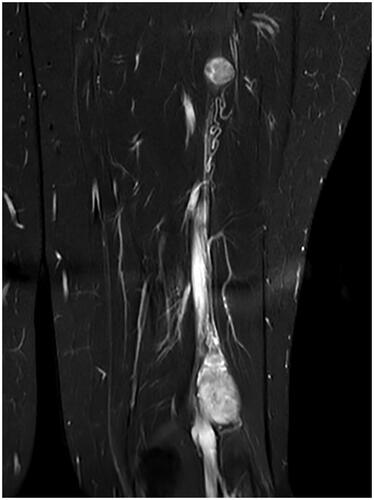 Figure 3. Hyperintense lesions on T2-weighted MRI scan without contrast.