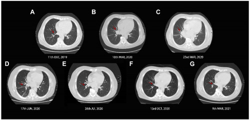 Figure 2 Chest CT examination, dynamic changes of the space-occupying lesions in lung. (A) regular chest CT: no space-occupying lesion in the right hilum. (B) regular chest CT: new-found multiple nodules in both lungs and space-occupying lesion in the right hilum. (C) enhanced chest CT: irregular nodules around the right lung hilum with mild enhancement, as well as right pleural effusion, enlarged mediastinal, and right hilar lymph nodes. (D) enhanced chest CT: smaller hilar lesion and hilar lymph nodes. (E) enhanced chest CT: a significant reduction in the size of lesions. (F–G) chest CT at follow-ups: no relapse of the lesions.