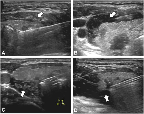 Figure 3. US images of traditional hydrodissection and improved hydrodissection. (A) Traditional hydrodissection before ablation. The strap muscles were swollen (white arrow), and a mixed echoic isolating band formed in this situation; the thyroid and anterior muscle were not effectively separated. (B) Improved hydrodissection in the ACS. The isolating fluid formed an anechoic isolating band (white arrow) and separated the strap muscles, effectively limiting the heat within the thyroid capsule. (C) Traditional hydrodissection before ablation. The hydrodissection area was filled with swollen soft tissue (white arrow). (D) Improved hydrodissection at the VS and POTS. The isolating fluid formed an anechoic isolating band (white arrow) and separated the muscles and trachea.