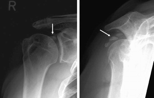 Figure 5. Radiographs of the right shoulder illustrating severe periarticular calcification (white arrows) of a patient (no. 30, Table 3) who was treated operatively with ORIF with screws for a major displaced fracture of the greater tuberosity. After radiographic healing, the metal was removed.