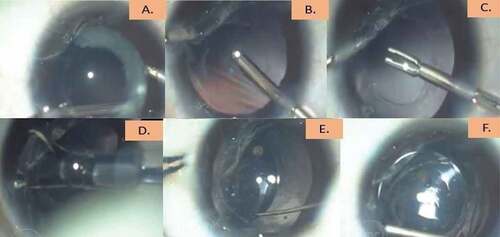 Figure 4. Procedure for in capsular bag fixation of IOL (A-F).