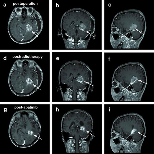 Figure 8. Postoperative ceMRI: transversal view (a), coronal view (b), and sagittal view (c). Postradiotherapy ceMRI: transversal view (d), coronal view (e), and sagittal view (f). ceMRI after treatment: transversal view (g), coronal view (h), and sagittal view (i).