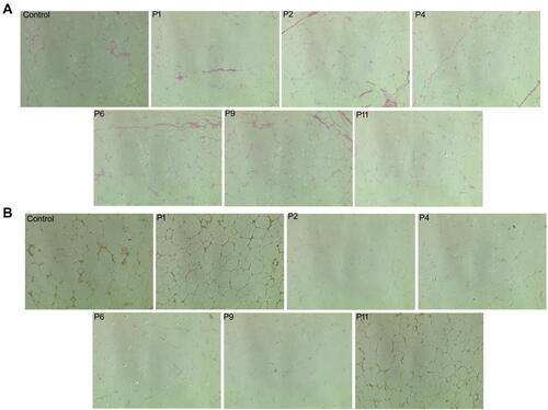 Figure 4 Confirmation of the ATLLM as a classic white adipose tissue with low CBLB expression in MSL. (A) H&E staining. The control SATs and PATs and MSL The SATs were subjected to tissue processing and staining for H&E. The data showed that there is no difference in either adipocyte size or morphology in the control and MSL SATs; however, there were abundant fibers in MSL SATs and smaller adipocyte size in control PATs. (B) Immunohistochemistry. The tissue sections were analyzed immunohistochemically for CBLB expression in the control, non-CBLB mutation (P1 and P11 patients), and the CBLB mutation (P2, P4, P6, and P9 patients). Strong expression of CBLB in controls and in non-CBLB mutation MSL patients, but there was low expression in CBLB mutation patients.