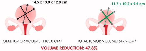 Figure 1. Patient 1 – uterine fibroid before and after treatment.