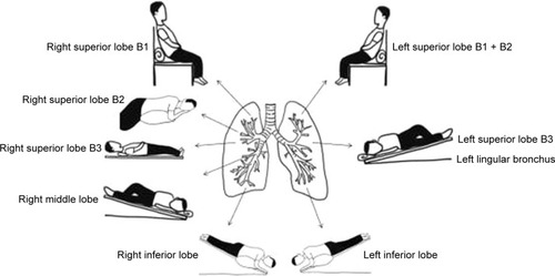 Figure 1 The sketch map of body positions for postural drainage.