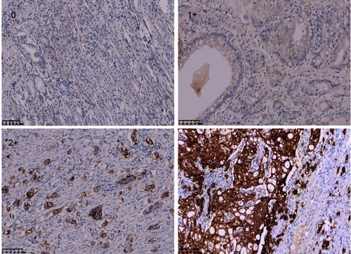 Figure 1 Human epidermal growth factor receptor 2 (HER2) expression by IHC (magnification ×200).