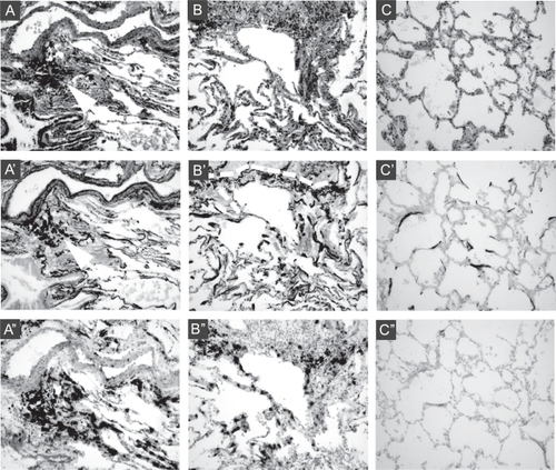 Figure 1 Abnormal morphology, elastic fiber accumulation, and elastin mRNA expression in CBO. Sections of peripheral lung tissue from CBO-affected lung (panels A and B), and control lung (panel C) were fixed without inflation, embedded, and sectioned at 5 μM. Serial sections were stained with H and E (A, B, C), for elastic fibers using Hart’s elastic fiber stain (A′, B′, C′), and hybridized in situ for elastin mRNA (A″, B″, C″). In panel A, a large vessel (top of each panel) is flanked by a large airway (bottom left of each panel) with accumulation of particulates, visible as black deposits, between the vessel and airway (indicated by white arrow in A and A′). A′ shows elastic laminae (stained black) in the intralobar pulmonary artery, and an increased density of elastic fibers beneath the epithelium of the large airway and the surrounding lung parenchyma compared to control (C′). A″ shows that elastin mRNA expression (black signal) is present in the large blood vessel, conducting airway, and particularly in tissue between these structures, and is significantly increased compared to control lung (C″). Panel B shows a large infiltrate (top of panels) flanked by surrounding tissue containing obliterated airways. Elastin staining in B′ indicates the infiltrate likely encompasses an airway, as there is a continuous elastic fiber (outlined by white dashed line) indicating a luminal structure has been present. Again, elastin density is increased compared to control lung (C’). B″ shows ongoing, intense elastin mRNA expression in tissue surrounding the infiltrate that is greater than that seen in control lung (C″).