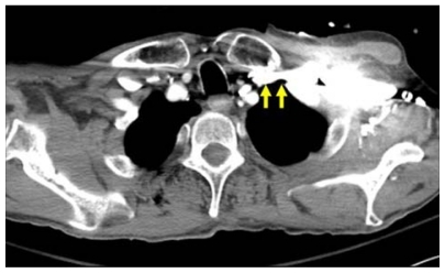 Figure 11 Computed tomography scan demonstrating apposition of left subclavian vein to pleura (arrows).