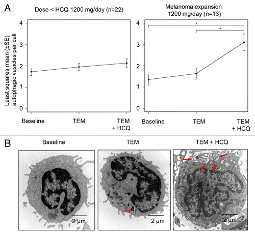 Figure 2. Pharmacodynamic effects of temsirolimus and hydroxychloroquine on autophagic vacuole accumulation in peripheral blood mononuclear cells (PBMC). (A) Mixed-effects model of mean ± SD autophagic vacuoles (AVs)/cell. *P < 0.05. (B) Representative electron micrographs from a patient treated with TEM and TEM + HCQ 600 mg/po bid. Arrows, AVs; scale bar: 2 µm.