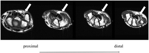 Figure 2. MRI findings revealed that the ulnar nerve (white arrow) run over the hook of hamate.