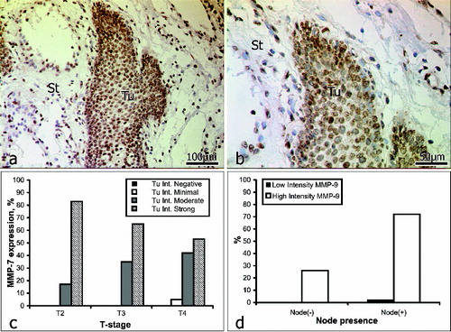 Figure 2. Immunoreactivity for MMP-7 (a and b): St = stroma; Tu = tumour. Correlation between MMP-7 expression intensity and tumour stage (c); lymph-node involvement (d).