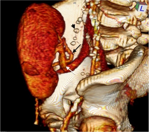 Figure 1 Three-dimensional CTA reconstruction.