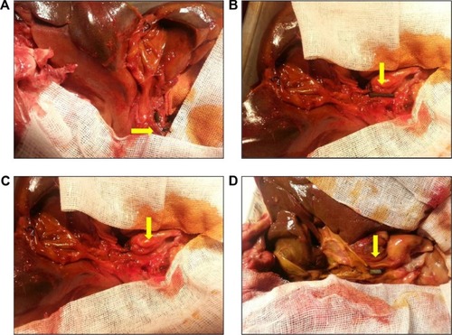 Figure 2 Open abdominal cavity of an experimental animal.Notes: Yellow arrows point to the AgNP-coated biliary stent and CBD ligation suture (A); AgNP-coated biliary stent, with the left end in the CBD, the right end in the duodenum, and the artificial narrowing formed by the ligature in the middle (B); the ampulla structure (C); the location of CBD stones in an animal with a Teflon biliary stent (D).Abbreviations: AgNP, silver nanoparticle; CBD, common bile duct.