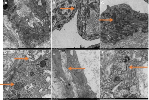 Figure 2 Electron micrographs of endothelial cells of normal veins (A) and arterialized veins in AVM rat model (B–E). (A) Normal organelles. (B) Occluding junction of vascular endothelial cells (indicated by arrow). (C) WP body (indicated by arrow). (D) Mitochondria swelling and lysosome formation (indicated by arrows). (E) Mitochondrial crista disappeared (indicated by arrow). (F) Endoplasmic reticulum swelling (indicated by arrow).