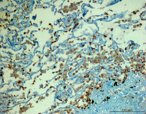 Figure 3. Focal (extensity score = 1) and weak (intensity score = 1) expression of AQP5 in MPM (AQP5, 200×).