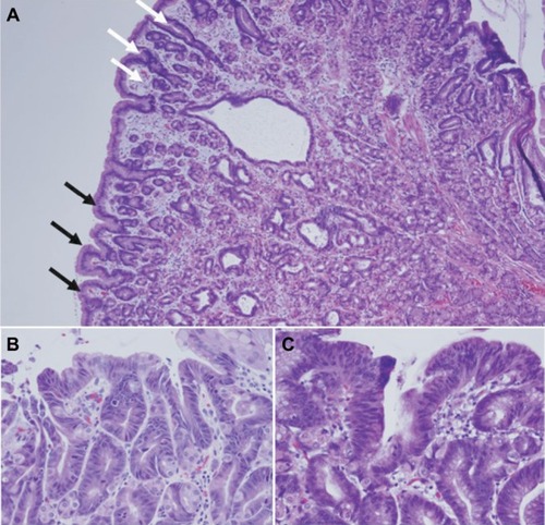 Figure 3 Histopathology of fundic gland polyps in GAPPS.