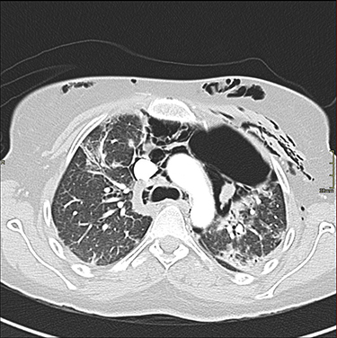 Figure 2 Axial chest CT with contrast showing the progression of the pneumomediastinum with air pockets in the left para-mediastinal region and subcutaneous emphysema.