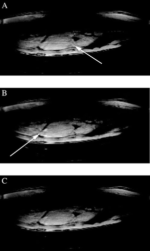 Figure 4. Reduction of image artifacts. A: Uncorrected, B: Corrected using diaphragm‐based scaling factors, C: Corrected using RaMP‐based scaling factors.