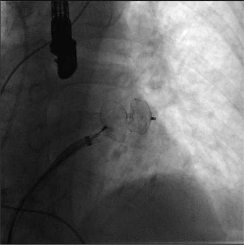 Figure 3 Fluoroscopic image of the final positioning steps of the Amplatzer cardiac plug device.