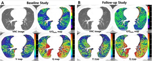 Figure 1 A 63-year-old male COPD patient. The sets of four axial images of baseline and follow-up are simultaneously displayed and evaluated using in-house software. On VNC images, mild centrilobular emphysema and bronchial wall thickening is noted. (A) Ventilation is decreased in right middle lobe, both lower lobes, and lingula of left upper lobe, while perfusion is relatively preserved resulting in the reversed V/Q pattern on the V/Qratio map on baseline study. (B) On follow-up images after three months of pharmacologic treatment, the V/Q patterns on V/Q map in these areas are shown as the matched V/Q pattern with improved ventilation. In this patient, quantified V was increased from 0.438 to 0.539 and quantified V/Qratio was increased from −0.981 to −0.473. FEV1 was improved by 0.58 L in this patient on follow-up.