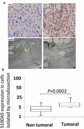 Figure 2. Immunohistochemistry studies and microdissection-based quantitative analysis of S100A9. (a) Immunoreactivities of S100A9; representative images of positive and negative S100A9 expression in normal bone tissues; representative images of positive and negative S100A9 expression in OS tissues. Original magnification, × 200. (b) A microdissection technique was used to isolate normal bone tissues and OS tissues from frozen sections, and total RNA extracted from these cells was subjected to quantitative analysis of S100A9 mRNA using real-time PCR. Differential expression of S100A9 mRNA was observed between normal bone tissues and OS tissues (P = 0.0002).