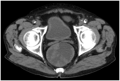 Figure 2. Computed tomography showing the giant villous adenoma of the colon in patient 2.