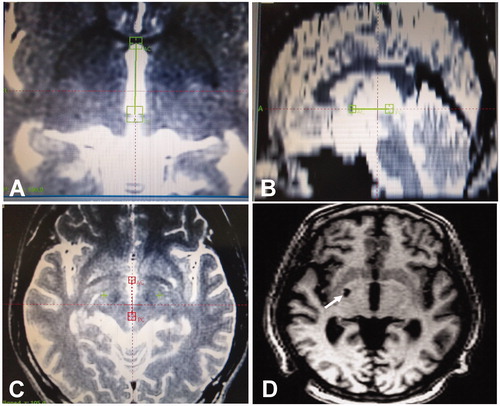 Figure 1. Seventeen-year-old man with refractory tic disorders treated with stereotactic radiofrequency thermocoagulation. A. Magnetic resonance imaging (MRI) scan performed for localization of the globus pallidus internus on the axial plane. B. Localization of the globus pallidus internus on the coronal plane of MRI. C. Targeted globus pallidus internus on both sides of the brain. D. Head MRI scan one year after the thermocoagulation, revealing the lesion of thermocoagulation in the right globus pallidus internus. The patient exhibited excellent improvement with no tic symptoms. The arrow indicates the damaged right globus pallidus internus.