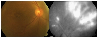 Figure 1 A) Color photograph of eye fundus before systemic steroid therapy B) fluorescein angiography – late phase – vasculitis as peripheric lesion.