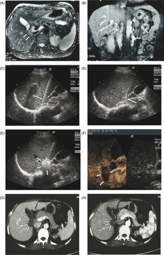 Figure 1. MW ablation in a 51-year-old woman with liver tumor adjacent to hepatic hilum. (A), (B) MRI before MW ablation showed tumor adjacent to hepatic hilum. (C) The place of antenna during MW ablation. (D) The place of absolute ethanol needle during MW ablation. (E) Tumor was covered by the hyperechoic microbubbles on gray-scale US. (F) CEUS showed no enhancement of the ablation zone at 1 day after treatment. Contrast-enhanced CT showed no enhancement of the ablation zone at six months (G) and twelve months (H) after treatment.