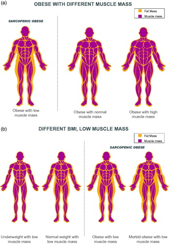 Figure 1. Body composition across the body weight continuum. Low muscle mass can occur in people with obesity (1a) and at any body weight (1b) BMI: body mass index.